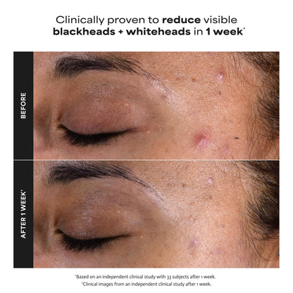 Paula's Choice SKIN PERFECTING 2% BHA Liquid Salicylic Acid Exfoliant, Daily Facial Exfoliator for Enlarged Pores, Wrinkles & Fine Lines, Fragrance-Free, Travel Size - 30 ml 🍁 All In One Marketplace Canada